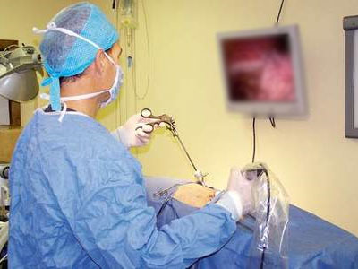 Γονιμότητα: Γυναικολογικές επεμβάσεις: Κοιλιακή υστερεκτομή με λαπαροσκοπική μέθοδο