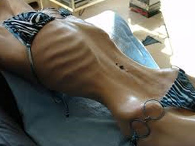 Γονιμότητα: Νευρογενής ανορεξία: Μια «κρυφή» επιδημία