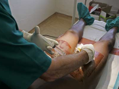 SEXUALITY:  Έχω φίμωση, τι να κάνω;