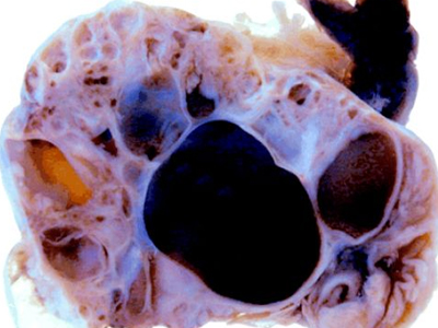 SEXUALITY: Το σύνδρομο των πολυκυστικών ωοθηκών