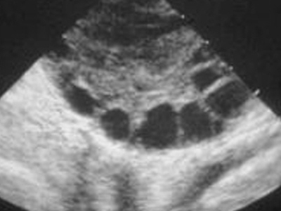 Γονιμότητα: Πολυκυστικές Ωοθήκες: Τα 9 βήματα για μια καλύτερη ζωή