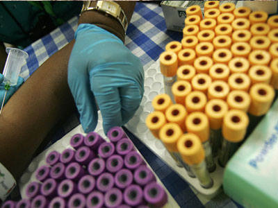 SEXUALITY: Πόσο σημαντικό είναι να καταγράφετε τις τιμές του PSA σας;