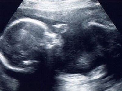 Γονιμότητα: Ενδομήτριος θάνατος: ένα σχετικά σπάνιο αλλά καταστροφικό γεγονός