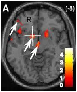 fMRI του εγκεφάλου κατά τη διάρκεια ενός χωρισμού