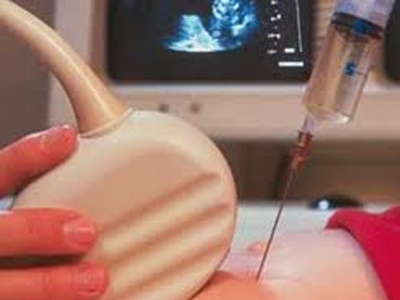 Γονιμότητα: Νέο τεστ προβλέπει την πιθανότητα αποβολής