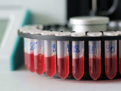 Τα υπέρ και τα κατά της εξέτασης του προστατικού αντιγόνου