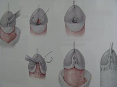 SEXUALITY: Πότε εμφανίζεται και ποια τα συμπτώματα του υποσπαδία;