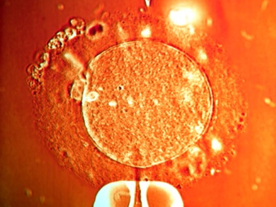 Γονιμότητα: Εξωσωματική γονιμοποίηση χωρίς φαρμακευτική αγωγή -6ο Στάδιο: Περαιτέρω μέθοδοι υποβοηθούμενης αναπαραγωγής