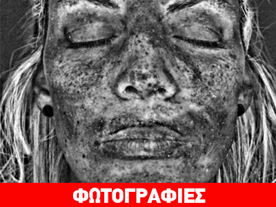 Οι αόρατες σοκαριστικές συνέπειες του μαυρίσματος