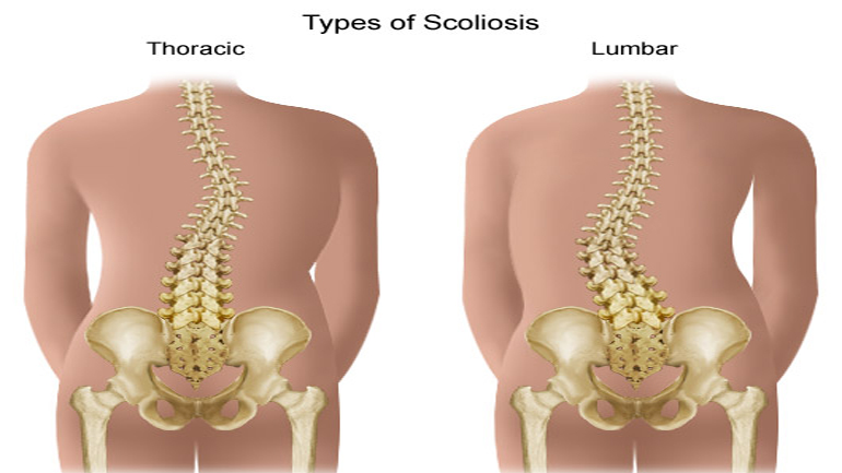 Δωρεάν έλεγχος σκολίωσης-κύφωσης για μαθητές στα δημοτικά πολυϊατρεία Πειραιά