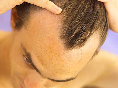 Η πρωτεΐνη της τριχόπτωσης