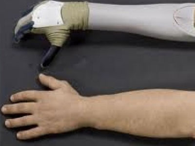 Πρωτοποριακό βιονικό χέρι αποκαθιστά τη χαμένη κινητικότητα