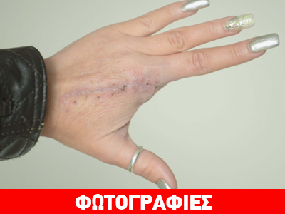 Αγγλία: H «μαύρη χήρα» την άφησε χωρίς δάκτυλο! Αγγλία: H «μαύρη χήρα» την άφησε χωρίς δάκτυλο!