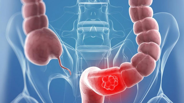 Δωρεάν προληπτικός έλεγχος για τον καρκίνο του παχέος εντέρου