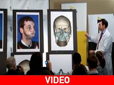 Επιτυχής μεταμόσχευση προσώπου στις Η.Π.Α.