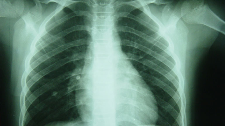 Π.Ο.Υ.: Φυματίωση και AIDS τα πιο θανατηφόρα λοιμώδη νοσήματα