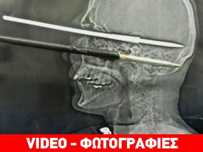 Βραζιλία: Αυτοκαμακώθηκε και επέζησε