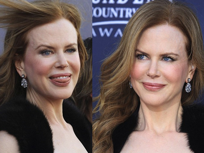 Εμφανή τα σημάδια του botox