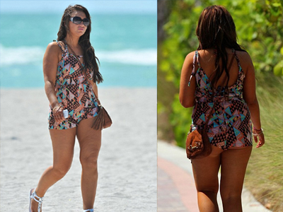 Αντιμέτωπη με την κυτταρίτιδα