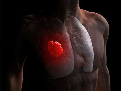 Παγκοσμίου φήμης ογκολόγοι σε συμπόσιο για τον καρκίνο του πνεύμονα