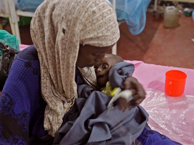 Ο υποσιτισμός πλήττει τα παιδιά στη Σομαλία