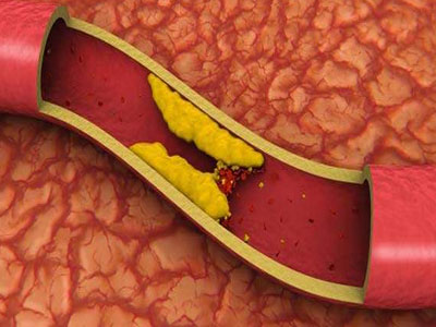 Και η χοληστερόλη έχει τις… εποχές της!